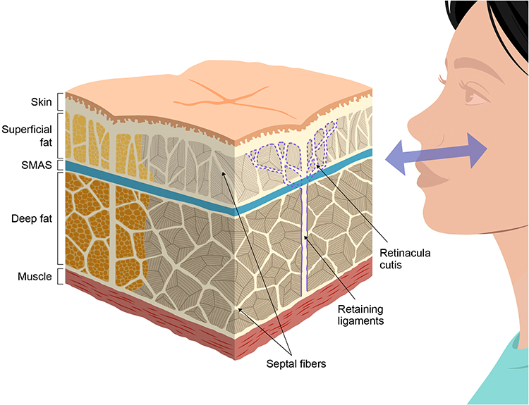 Conceptual Approaches to Facial Lifting Using Hyaluronic Acid Fillers: An Anatomical and Biomechanical Perspective