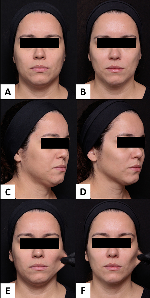 Aesthetic Use of Poly-L-Lactic Acid and Hyaluronic Acid Fillers in Medication-Driven Weight Loss Due to GLP-1 Receptor Agonists: Real-World Case Series from Latin America