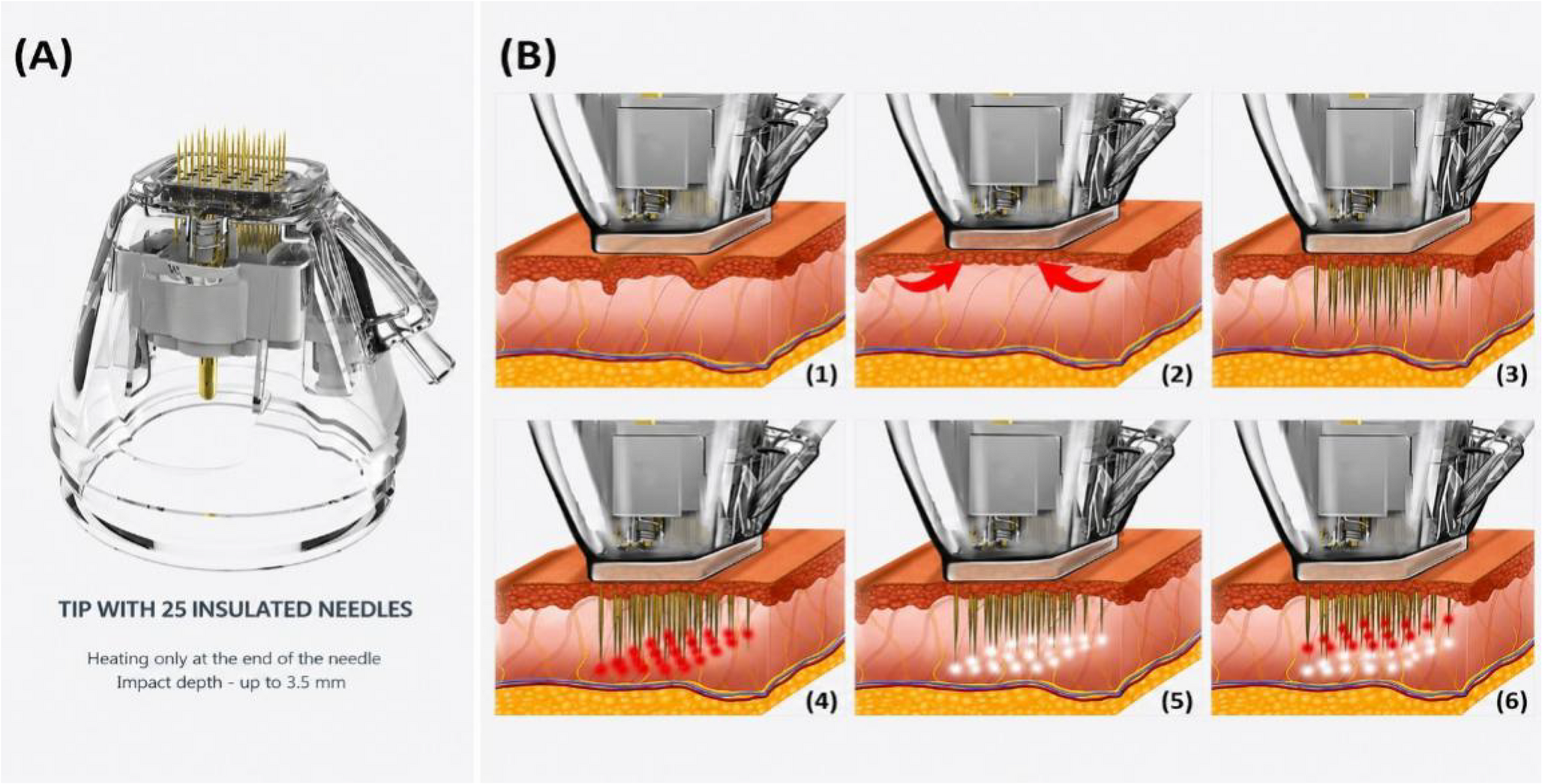 Dual-depth 25-pin insulated microneedle radiofrequency for moderate-to-severe periorbital wrinkles