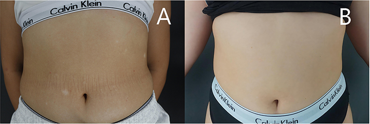 Oral Ivarmacitinib for Stable Vitiligo: Preliminary Observations from a Three-Patient Case Series