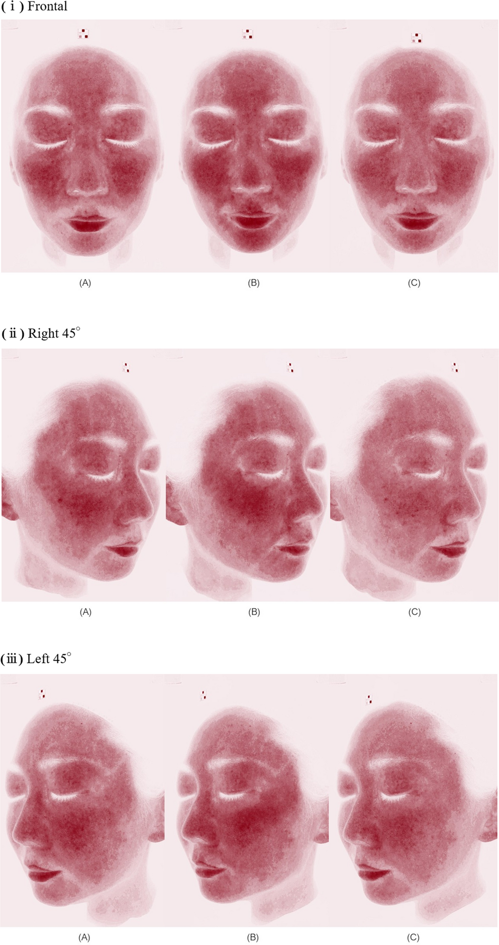 Efficacy of nano-sized ultrafine water clusters in reducing erythema following fractionated picosecond alexandrite laser treatment: a split-face, randomized, evaluator-blinded pilot study