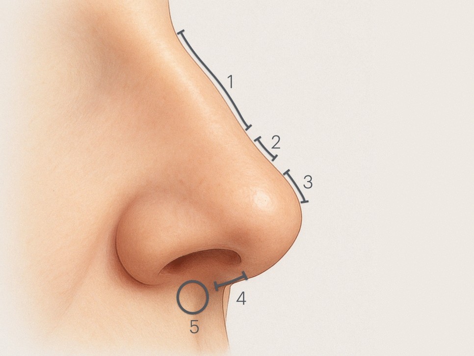 Standardized Non-surgical Rhinoplasty with Hyaluronic Acid: Consistent Outcomes Across Injectors with Varying Experience