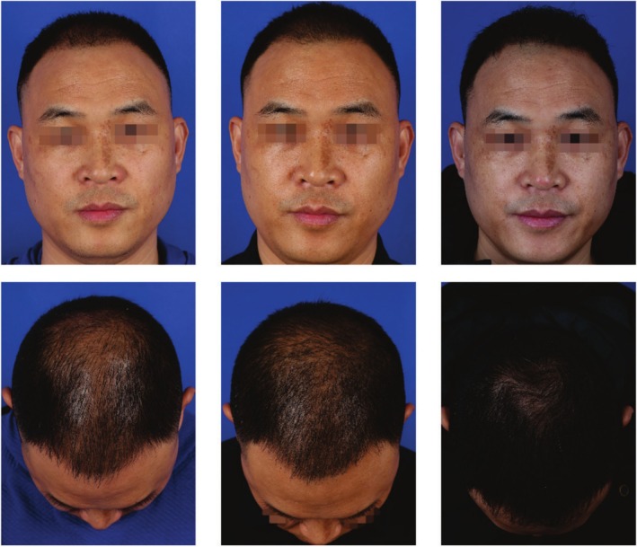 FIGURE 2. Typical case image of study group patient. Photographs of the experimental group patient who received combined rb‐bFGF and FUE treatment are shown at the preoperative stage (left), 6 (middle), and 12 (right) months posttreatment. Postoperative evaluations revealed significantly increased hair density, demonstrating excellent therapeutic outcomes.