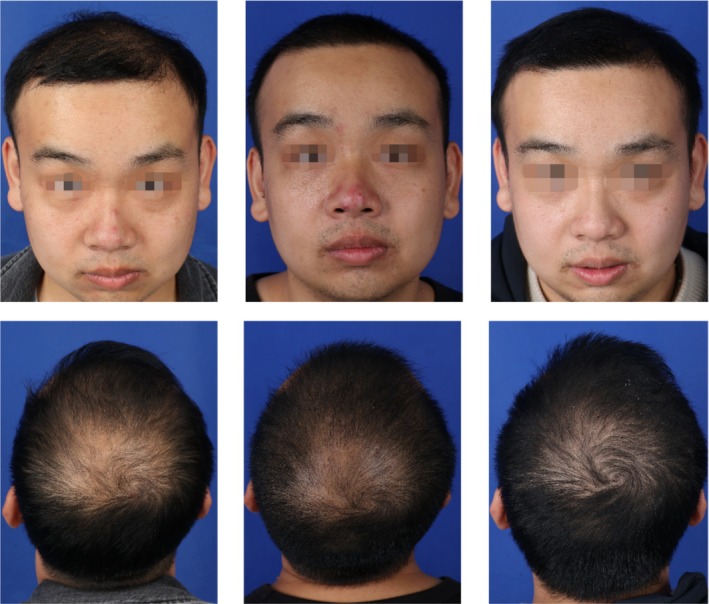 重组牛碱性成纤维细胞生长因子(rb-bFGF)在毛发移植中的疗效与安全性:前瞻对照研究