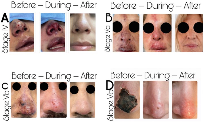 FIGURE 4. Representative clinical photographs of different VO stage showing signs and skin quality before, during and after treatment with ARDIP. The stages evaluated (A) Stage IV vascular occlusion showing early ischemic skin changes before treatment, intermediate clinical evolution during ARDIP therapy, and complete epithelial recovery after treatment. (B) Stage Va lesion demonstrating progressive tissue reperfusion and resolution following ARDIP intervention. (C) Stage Vb necrotic lesion showing initial ischemic damage, intermediate reparative phase, and final healed outcome. (D) Advanced Stage Vb necrosis with progressive improvement and restoration of skin integrity after treatment.