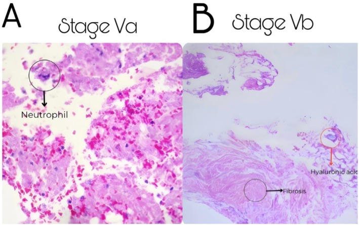 FIGURE 3. Compound microscopy histopathological findings from necrotic eschar specimens (A) Specimen obtained from a Stage Va necrotic eschar; Dense acute inflammatory infiltrate predominantly composed of neutrophils, fibrin deposition. (B) Specimen obtained from a Stage Vb necrotic eschar; Residual dermal filler material as basophilic amorphous/linear deposits within the dermis, associated with stromal fibrosis.