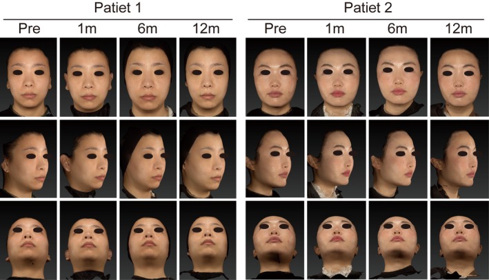 FIGURE 3. Representative clinical photographs of two patients who received nasal augmentation with CaHA. Images were obtained at baseline (pretreatment), and at Months 1, 6, and 12 following the procedure. For each time point, frontal, lateral (45‐degree), and basal views are presented to comprehensively illustrate the nasal contour changes.