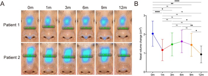 FIGURE 4. Three‐dimensional volumetric analysis of nasal changes following CaHA augmentation. (A) Representative 3D reconstructions of two patients at baseline and each follow‐up time point (Months 0, 1, 3, 6, 9, and 12 posttreatment). Color mapping (blue) indicates regions of volume increase relative to baseline, visualizing the dynamic volumetric changes over time. (B) Quantitative analysis of nasal volume changes over the 12‐month follow‐up period. * p < 0.05; ** p < 0.01; **** p < 0.0001; ns, p > 0.05 versus baseline.