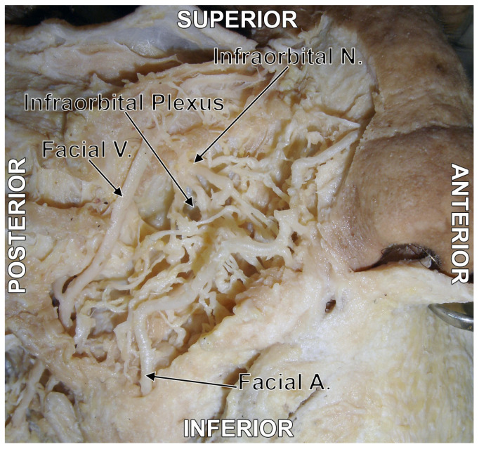 Figure 4. Original dissection of the infraorbital plexus. Right side. Infero-lateral view. Key labelled structures: infraorbital nerve (V2), buccal branch of CN VII, infraorbital plexus convergence zone.