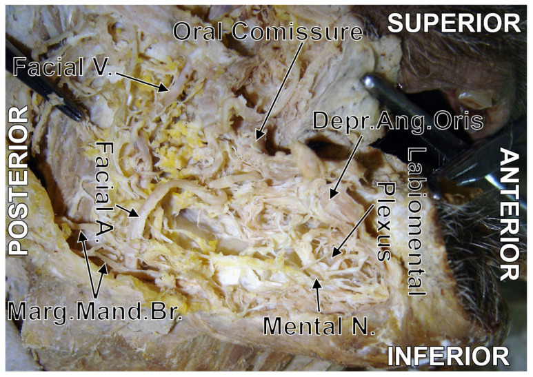 Figure 5. Original dissection of the labiomental plexus. Right side. Lateral view. Key labelled structures: mental nerve (V3), marginal mandibular branch of CN VII, communicating branches.