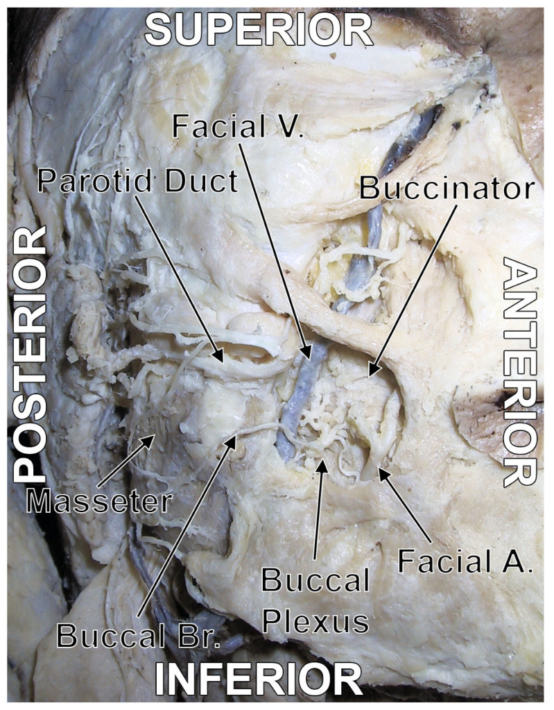 Figure 6. Original dissection of the buccal plexus. Right side. Antero-lateral view. Key labelled structures: buccal branch of CN VII, buccal nerve (V3), communicating branches.