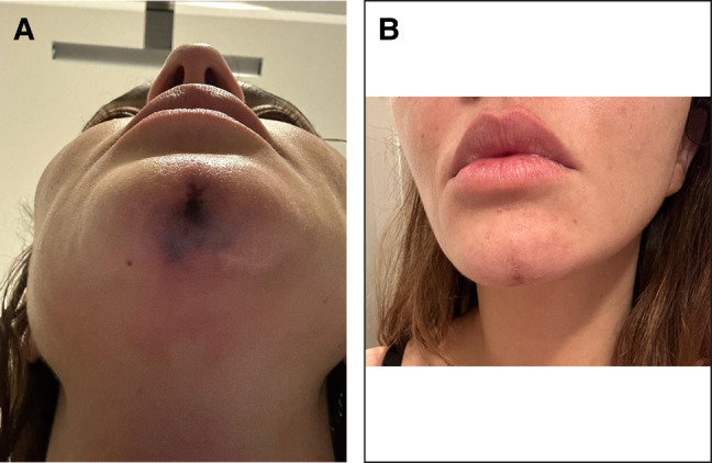Figure 2.. A 34-year-old female, complaining of skin vascular compromise at chin level. (A) One day after hyaluronic acid injection, and (B) 20 days after hyaluronidase treatment.