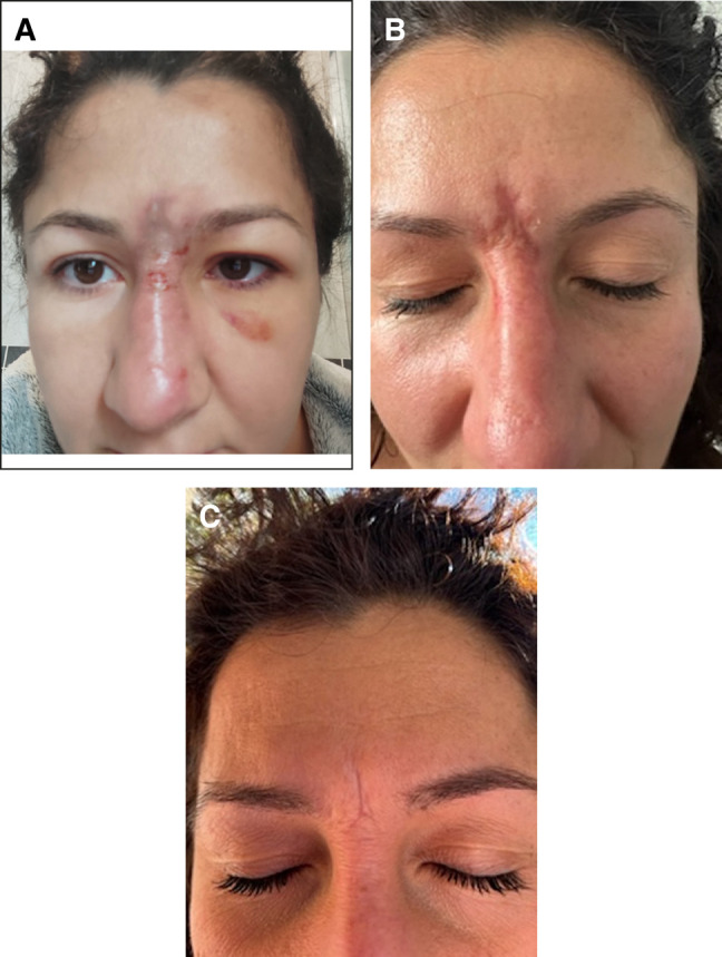 Figure 3.. A 38-year-old female, complaining of skin lesion at the nose and glabella. (A) Self-made picture showing the skin damage a few days after hyaluronic acid (HA) injection, (B) when she came for consultation, 38 days after HA injection, and (C) 20 days after hyaluronidase treatment.