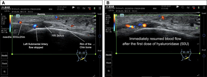 Figure 4.. (A) Ultrasound examination showing a hyaluronic acid bolus blocking the left submental artery flow. Injection of hyaluronidase 50 IU, ultrasound-guided, directly into the bolus. (B) Ultrasound examination showing the immediate flow resumption following hyaluronidase injection.