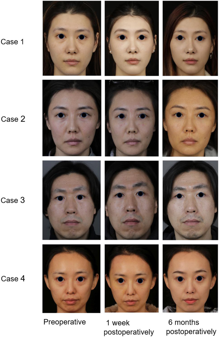 Figure 2. Case 1: A 30-year-old woman presented with a preoperative Barton score of 3, which improved to 0 postoperatively. Case 2: A 26-year-old woman improved from a Barton score of 2 to 0. Case 3: A 29-year-old man had a Barton score of 3 preoperatively and 0 postoperatively. Case 4: A 32-year-old woman had a Barton score of 4 preoperatively and 0 postoperatively. All four patients underwent transconjunctival orbital fat release, repositioning, and secure fixation for the correction of lower eyelid bags combined with tear trough deformities. Follow-up evaluations revealed marked improvement in both lower eyelid fullness and tear trough contour.