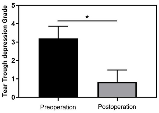 Figure 3. Change in tear trough depth before and after surgery (* p < 0.05 indicates statistical significance).