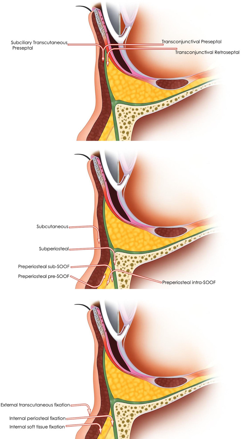 Fig. 2.. ChatGPT-generated figure demonstrating (A) STC and TC surgical access incisions and preseptal and retroseptal dissection planes, various pocket dissections for FT (B), and different fat fixation methods (C).