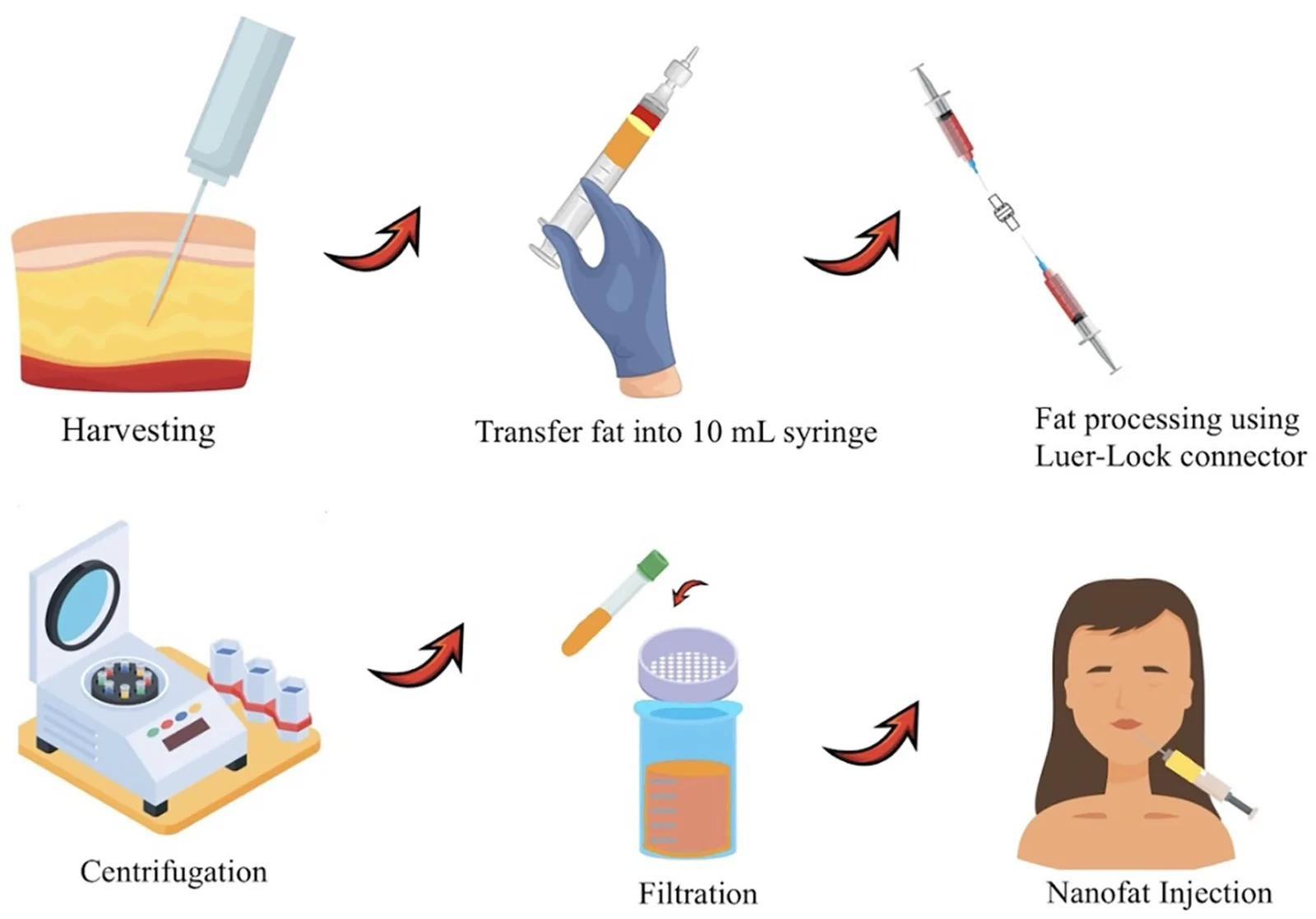 纳米脂肪在整形外科中的临床应用与安全性系统综述