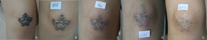 皮秒与Q开关1064nm激光洗纹身对比：总体疗效相当，皮秒激光优等清除率更高、所需次数更少