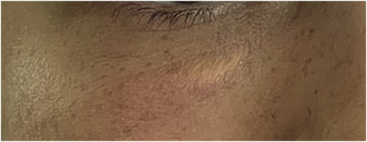 Fig 10 黄斑瘤样病变