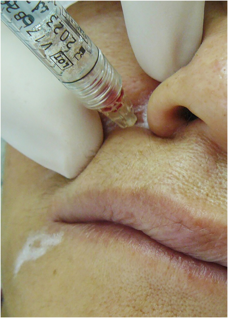Fig 12 回抽阳性