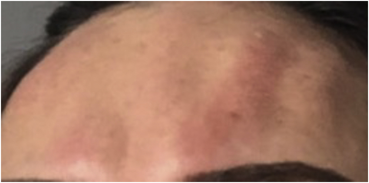 Fig 4 荨麻疹反应