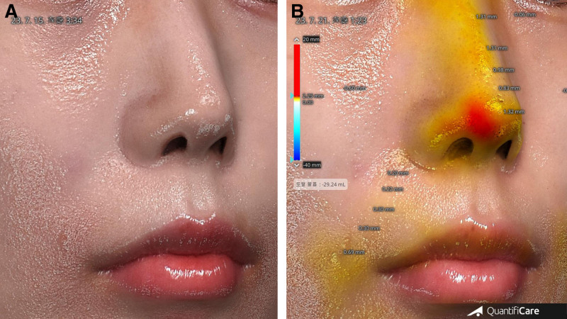Fig 8 术后1周3D扫描