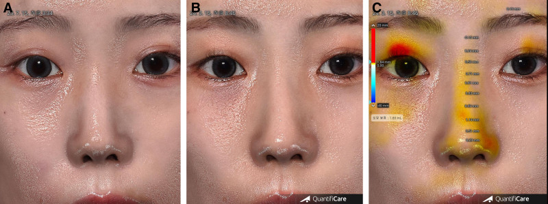 Fig 9 术后9个月3D扫描