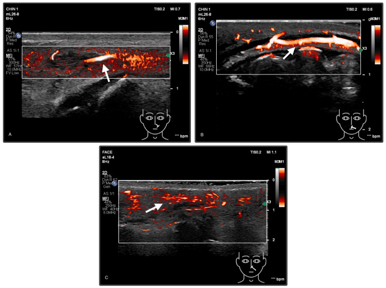 术后随访超声对比