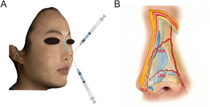 Figure 2: Schematic diagram of CaHA injection